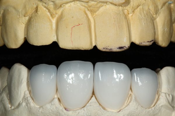 phuc-hinh-su-cercon-2