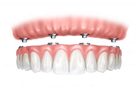 ham-phu-tren-implant-(thanh-bar)-19