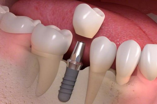 phuong-phap-moi-cho-phuc-hinh-tren-implant-24