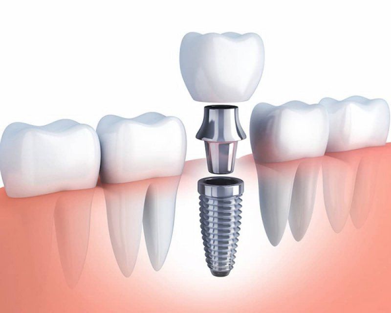 phuc-hinh-su-kim-loai-tren-implant-17